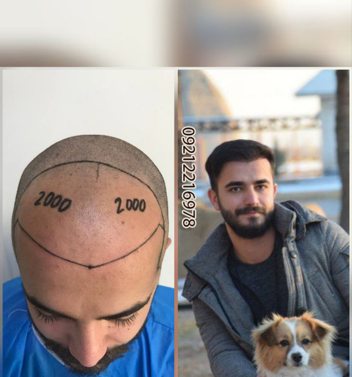 کاشت مو طبیعی ارومیه کاشت