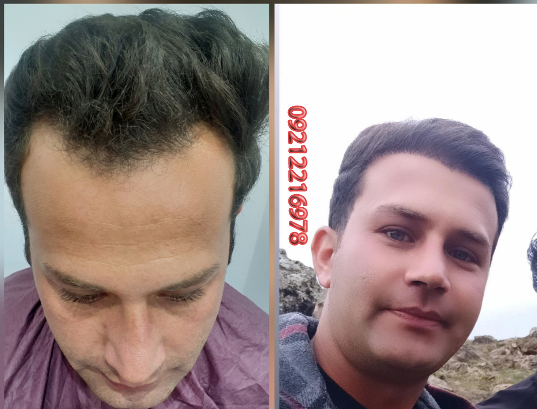 تنها مرکز کاشت مو با شکاف های افقی در ارومیه